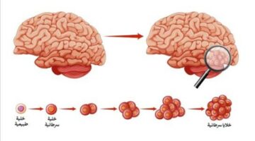مرض صامت.. تعرف على أعراض سرطان المخ – الجريدة